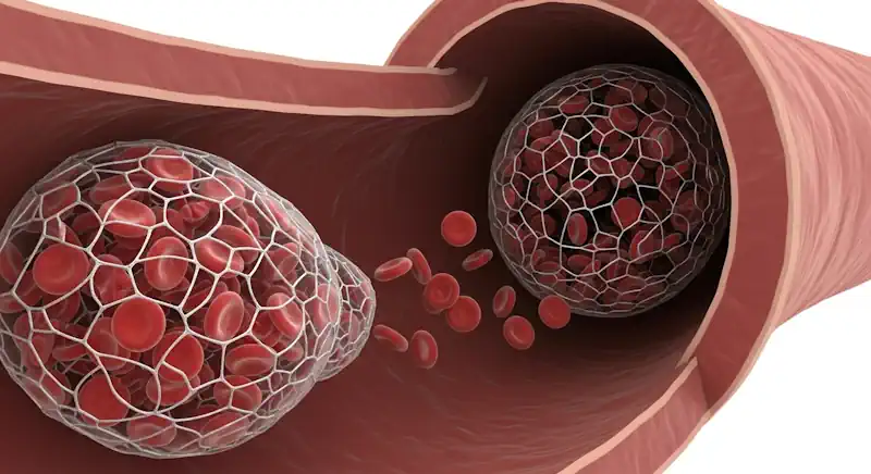 An illustration of a blood clot forming within a blood vessel, obstructing the flow of red blood cells.